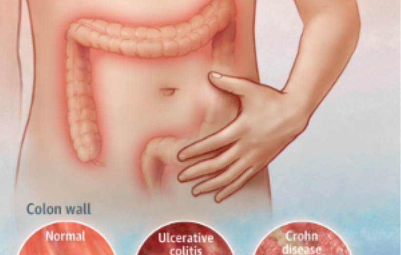 پاورپوینت Inflammatory Bowel Disease